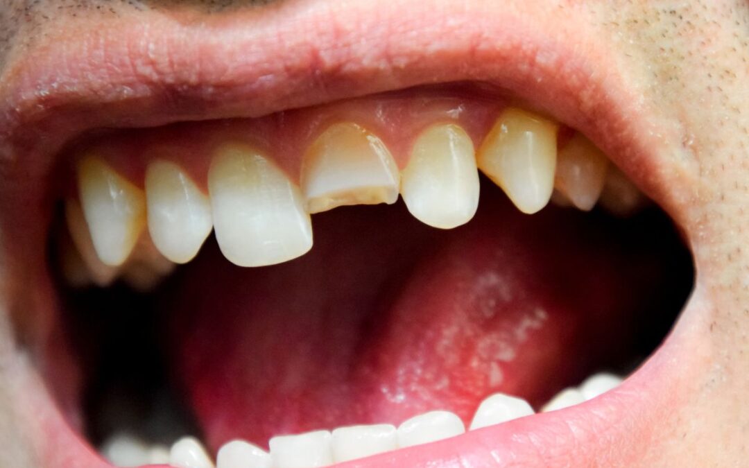 Dental Emergencies: What to Do When You Break a Tooth
