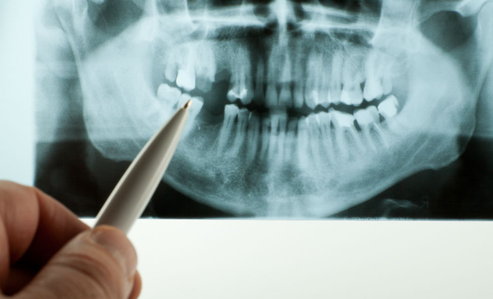 What Is A Root Canal & How Can I Prevent One?