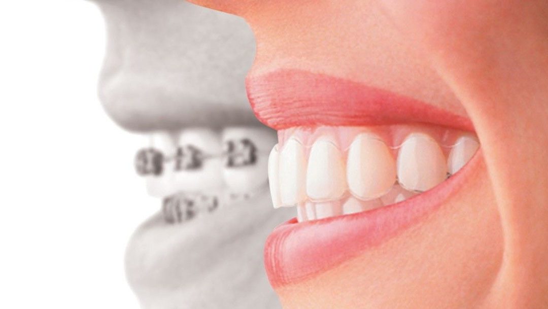 Dental Crowns vs Dental Implants: Which One Is For Me?