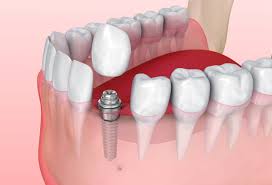 Dental Implants in Gilbert AZ