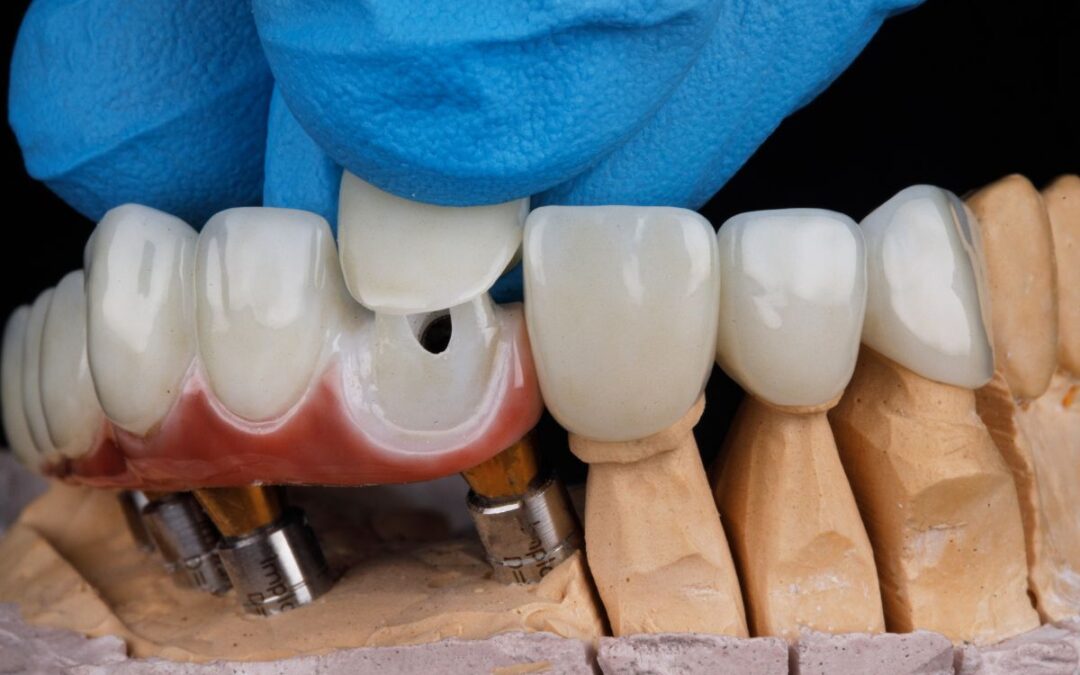 Dental Veneer Maintenance