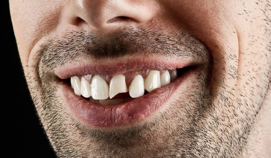 4 Common Things That Can Chip A Tooth