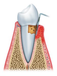 Periodontitis - Gum Disease Treatment Gilbert AZ