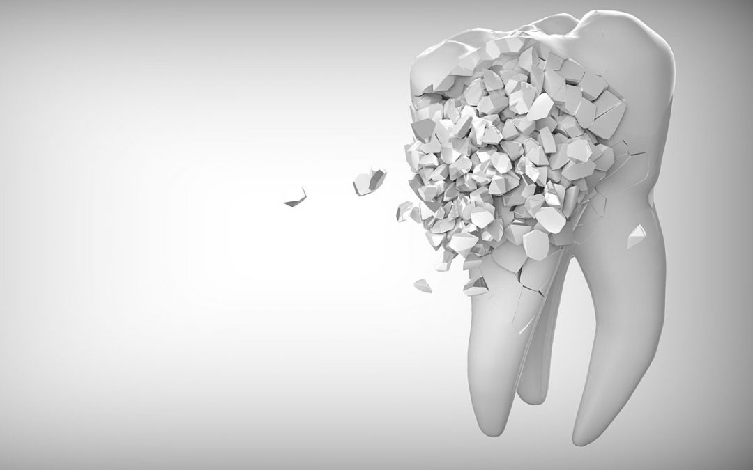 8 Common Reasons For Needing A Tooth Pulled