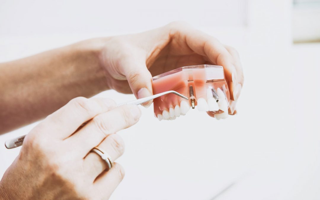 Tooth Replacement Options: Dentures, Bridges & Implants