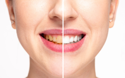 Professional Teeth Whitening vs. At-Home Whitening